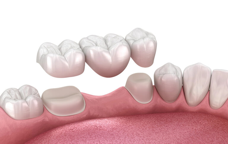 How Does Sleep Dentistry Calm Your Worst Dental Anxiety? Addressing dental anxiety requires understanding the emotional weight of dental fear and providing compassionate, patient-centred solutions.